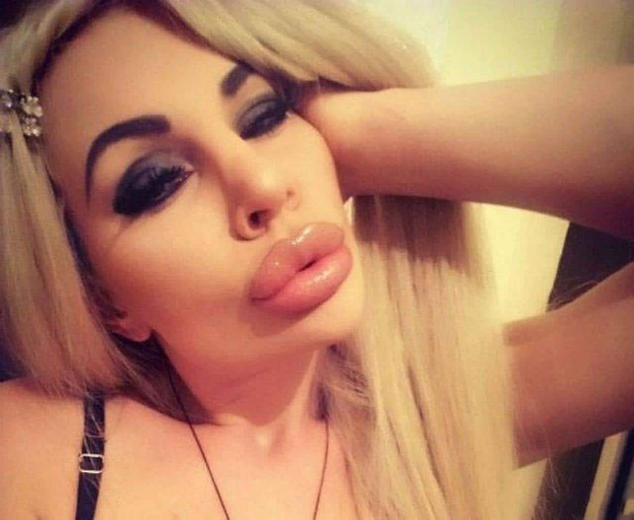 Botox Lips Porn - Crazy HUGE Lips Fail: Girls Who Took Lip Injections A Little ...