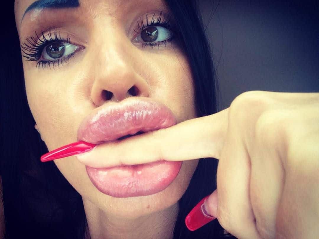 Yellow Lipstick Porn - Crazy HUGE Lips Fail: Girls Who Took Lip Injections A Little ...